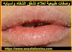  وصفات طبيعية لعلاج تشقق الشفاه واسبابه