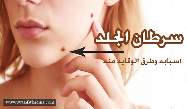 طرق الوقاية من سرطان الجلد واسبابه